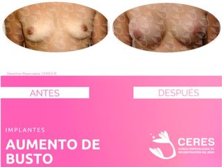 Antes y después de  Aumento de Busto