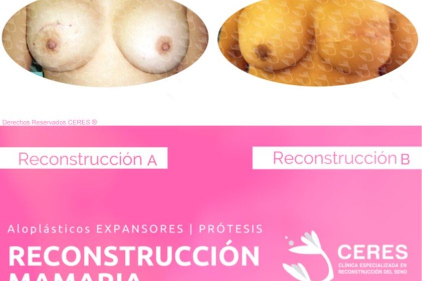 Reconstrucción mamaria antes y después - 591408