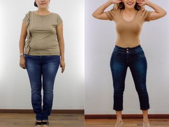 Mommy makeover - 662666