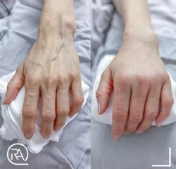 Rejuvenecimiento de manos - Dr. RAQ