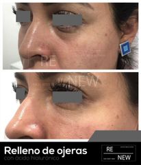 Antes y después de Relleno de ojeras - Ácido Hialurónico 