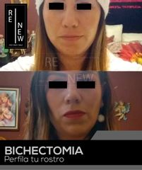 Antes y después de Bichectomia