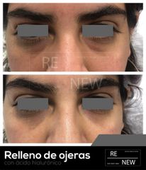 Antes y después de Relleno de ojeras - Ácido Hialurónico 