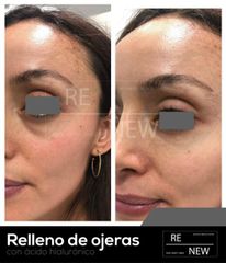 Antes y después de Relleno de ojeras - Ácido Hialurónico 