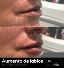 Antes y después de Aumento de labios