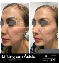 Antes y después de Lifting 