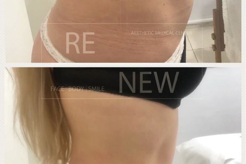 Lipólisis antes y después - 649827