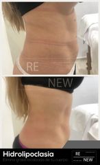Antes y después de Hidrolipoclasia
