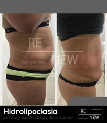Antes y después de Hidrolipoclasia