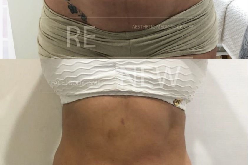 Lipólisis antes y después - 649829