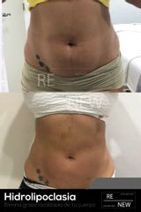 Antes y después de Hidrolipoclasia