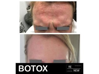 Antes y después de Aplicación de toxina botulínica