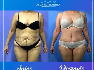 Antes y después de Abdominoplastia Liposucción Dr Carlos Roblero