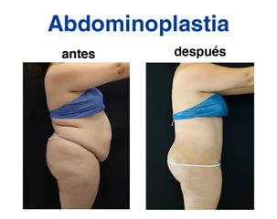 Abdominoplastia - Dr. Lenin Alfonso Reyes Ibarra