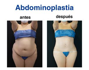 Abdominoplastia - Dr. Lenin Alfonso Reyes Ibarra