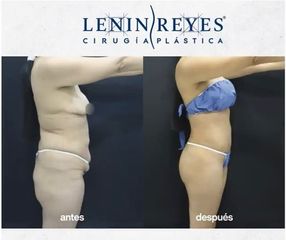 Abdominoplastia - Dr. Lenin Alfonso Reyes Ibarra