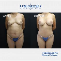 Abdominoplastia - Dr. Lenin Alfonso Reyes Ibarra