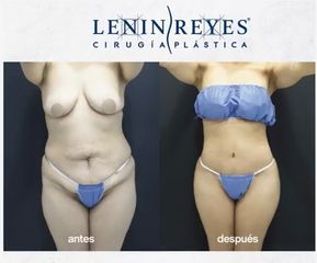Abdominoplastia - Dr. Lenin Alfonso Reyes Ibarra