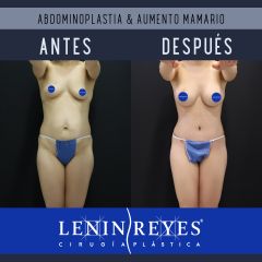 Abdominoplastia - Dr. Lenin Alfonso Reyes Ibarra