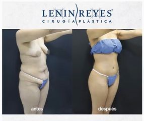 Abdominoplastia - Dr. Lenin Alfonso Reyes Ibarra