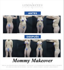 Mommy makeover - Dr. Lenin Alfonso Reyes Ibarra