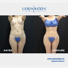 Abdominoplastia - Dr. Lenin Alfonso Reyes Ibarra