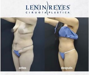 Abdominoplastia - Dr. Lenin Alfonso Reyes Ibarra