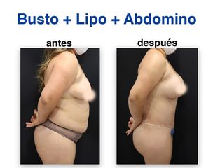 Abdominoplastia - Dr. Lenin Alfonso Reyes Ibarra
