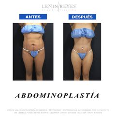 Abdominoplastia - Dr. Lenin Alfonso Reyes Ibarra