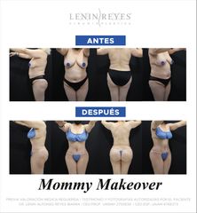 Mommy makeover - Dr. Lenin Alfonso Reyes Ibarra