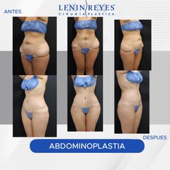 Abdominoplastia - Dr. Lenin Alfonso Reyes Ibarra