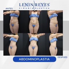 Abdominoplastia - Dr. Lenin Alfonso Reyes Ibarra