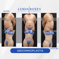 Abdominoplastia - Dr. Lenin Alfonso Reyes Ibarra