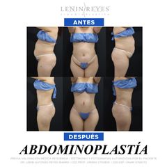 Abdominoplastia - Dr. Lenin Alfonso Reyes Ibarra