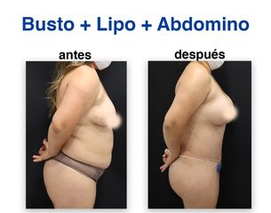 Abdominoplastia - Dr. Lenin Alfonso Reyes Ibarra