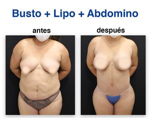 Abdominoplastia - Dr. Lenin Alfonso Reyes Ibarra