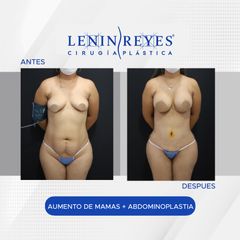 Abdominoplastia - Dr. Lenin Alfonso Reyes Ibarra
