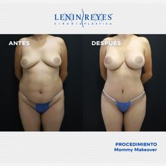 Abdominoplastia - Dr. Lenin Alfonso Reyes Ibarra