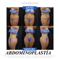 Abdominoplastia - Dr. Lenin Alfonso Reyes Ibarra
