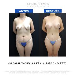 Abdominoplastia - Dr. Lenin Alfonso Reyes Ibarra