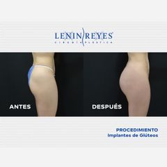 Gluteoplastia - Dr. Lenin Alfonso Reyes Ibarra