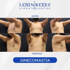 Ginecomastia - Dr. Lenin Alfonso Reyes Ibarra