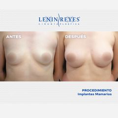 Aumento de busto - Dr. Lenin Alfonso Reyes Ibarra