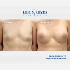 Aumento de busto - Dr. Lenin Alfonso Reyes Ibarra
