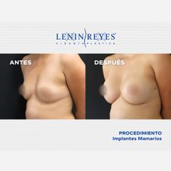 Aumento de busto - Dr. Lenin Alfonso Reyes Ibarra