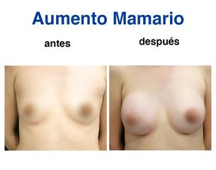 Aumento de busto - Dr. Lenin Alfonso Reyes Ibarra