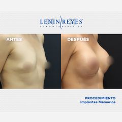 Aumento de busto - Dr. Lenin Alfonso Reyes Ibarra