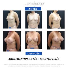 Mastopexia - Dr. Lenin Alfonso Reyes Ibarra