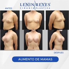 Aumento de busto - Dr. Lenin Alfonso Reyes Ibarra