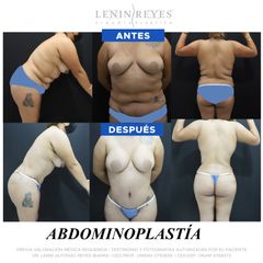 Abdominoplastia - Dr. Lenin Alfonso Reyes Ibarra